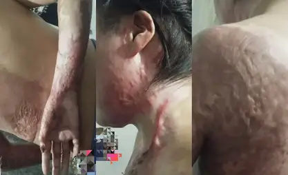 Аялын өрттөгөн киши Талас мэриясында иштейт. Милиция окуяны териштирүүдө