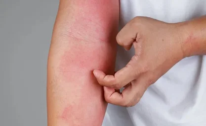 allergiya-na-rybu-s.2e16d0ba.format-webp.fill-1668x1014.webp