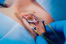 femto-lasik.jpg