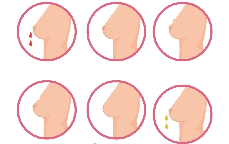 rak-grudi-simptomy.width-800